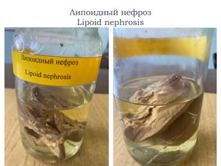 Липоидный нефроз
Lipoid nephrosis
 