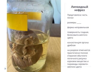 Липоидный
нефроз
Представлена часть
почки
____
размеры
форма неправильная
,
поверхность гладкая
-
белесовато жёлтого
цвета
консистенция органа
дряблая
на разрезе отмечается
практически полное
стирание обычного
почечного рисунка
корковое вещество и
-
пирамиды серовато
жёлтого цвета
 