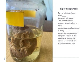 Lipoid nephrosis
Part of a kidney shown
sizes ____
the shape is irregular
The outer surface is
smooth, whitish-yellow in
color
the consistency of the organ
is flabby
the section shows almost
complete erasure of the
usual renal pattern; the
cortex and pyramids are
grayish-yellow in color
 