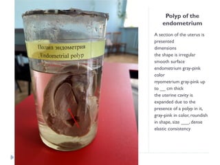 Polyp of the
endometrium
A section of the uterus is
presented
dimensions
the shape is irregular
smooth surface
endometrium gray-pink
color
myometrium gray-pink up
to __ cm thick
the uterine cavity is
expanded due to the
presence of a polyp in it,
gray-pink in color, roundish
in shape, size ___, dense
elastic consistency
 