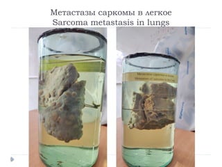 Метастазы саркомы в легкое
Sarcoma metastasis in lungs
 