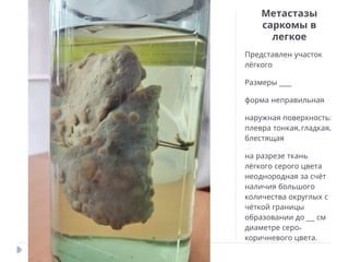 Метастазы
саркомы в
легкое
Представлен участок
лёгкого
___
Размеры
форма неправильная
:
наружная поверхность
, ,
плевра тонкая гладкая
блестящая
на разрезе ткань
лёгкого серого цвета
неоднородная за счёт
наличия большого
количества округлых с
чёткой границы
__
образовании до см
-
диаметре серо
.
коричневого цвета
 