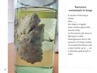 Sarcoma
metastasis in lungs
A section of the lung is
shown
Sizes ___
the shape is irregular
outer surface: pleura thin,
smooth, shiny
on the section, the tissue is
light gray in color,
heterogeneous due to the
presence of a large number
of rounded formations with
a clear border up to __ cm
in diameter, gray-brown in
color.
 