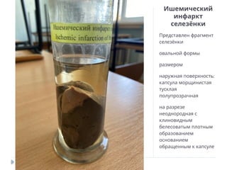 Ишемический
инфаркт
селезёнки
Представлен фрагмент
селезёнки
овальной формы
размером
:
наружная поверхность
капсула морщинистая
тусклая
полупрозрачная
на разрезе
неоднородная с
клиновидным
белесоватым плотным
образованием
основанием
обращенным к капсуле
 