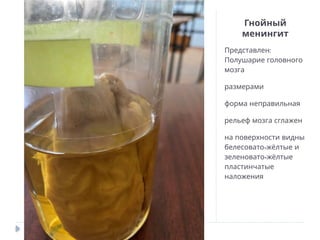 Гнойный
менингит
:
Представлен
Полушарие головного
мозга
размерами
форма неправильная
рельеф мозга сглажен
на поверхности видны
-
белесовато жёлтые и
-
зеленовато жёлтые
пластинчатые
наложения
 