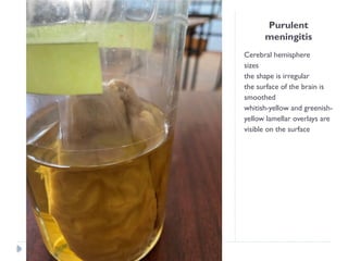 Purulent
meningitis
Cerebral hemisphere
sizes
the shape is irregular
the surface of the brain is
smoothed
whitish-yellow and greenish-
yellow lamellar overlays are
visible on the surface
 