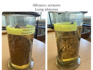 Абсцесс легкого
Lung abscess
 