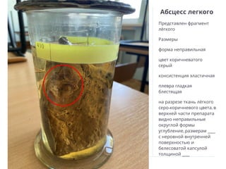 Абсцесс легкого
Представлен фрагмент
лёгкого
Размеры
форма неправильная
цвет коричневатого
серый
консистенция эластичная
плевра гладкая
блестящая
на разрезе ткань лёгкого
- ,
серо коричневого цвета в
верхней части препарата
видно неправильные
округлой формы
, ___
углубление размерам
с неровной внутренней
поверхностью и
белесоватой капсулой
___
толщиной
 