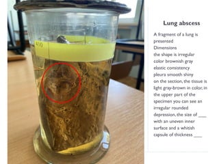 Lung abscess
A fragment of a lung is
presented
Dimensions
the shape is irregular
color brownish gray
elastic consistency
pleura smooth shiny
on the section, the tissue is
light gray-brown in color, in
the upper part of the
specimen you can see an
irregular rounded
depression, the size of ___
with an uneven inner
surface and a whitish
capsule of thickness ___
 