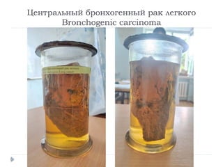 Центральный бронхогенный рак легкого
Bronchogenic carcinoma
 