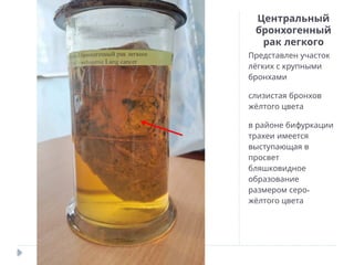 Центральный
бронхогенный
рак легкого
Представлен участок
лёгких с крупными
бронхами
слизистая бронхов
жёлтого цвета
в районе бифуркации
трахеи имеется
выступающая в
просвет
бляшковидное
образование
-
размером серо
жёлтого цвета
 