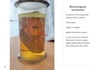 Bronchogenic
carcinoma
A section of the lungs with
large bronchi is shown
Dimensions
Shape is irregular
yellow bronchial mucosa
in the area of ​
​
the tracheal
bifurcation there is a gray-
yellow plaque-like formation
protruding into the lumen
 