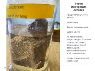 Бурая
индурация
легкого
Представлен участок
лёгкого
размерами
форма неправильная
бурого цвета
на поверхности
разреза видно большое
количество тонких
белесоватых тяжей
равномерно
расположенных по
всей поверхности
-
консистенция плотно
эластичная
 