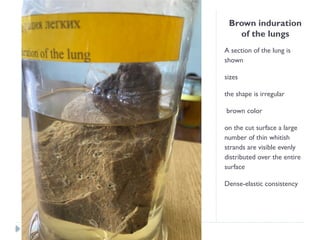 Brown induration
of the lungs
A section of the lung is
shown
sizes
the shape is irregular
brown color
on the cut surface a large
number of thin whitish
strands are visible evenly
distributed over the entire
surface
Dense-elastic consistency
 