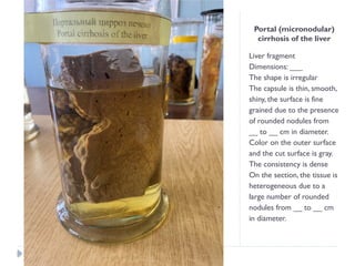 Portal (micronodular)
cirrhosis of the liver
Liver fragment
Dimensions: ___
The shape is irregular
The capsule is thin, smooth,
shiny, the surface is fine
grained due to the presence
of rounded nodules from
__ to __ cm in diameter.
Color on the outer surface
and the cut surface is gray.
The consistency is dense
On the section, the tissue is
heterogeneous due to a
large number of rounded
nodules from __ to __ cm
in diameter.
 
