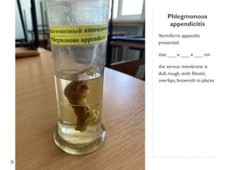 Phlegmonous
appendicitis
Vermiform appendix
presented
size ___ x ___ x ___ cm
the serous membrane is
dull, rough, with fibiotic
overlays, brownish in places
 