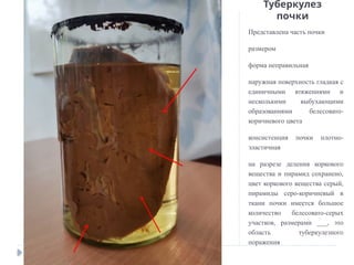 Туберкулез
почки
Представлена часть почки
размером
форма неправильная
наружная поверхность гладкая с
единичными втяжениями и
несколькими выбухающими
образованиями белесовато-
коричневого цвета
консистенция почки плотно-
эластичная
на разрезе деления коркового
вещества и пирамид сохранено,
цвет коркового вещества серый,
пирамиды серо-коричневый в
ткани почки имеется большое
количество белесовато-серых
участков, размерами ___, это
область туберкулезного
поражения
 