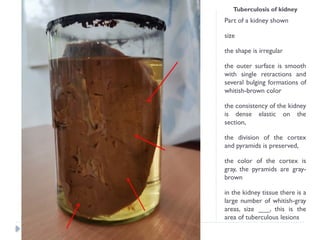 Tuberculosis of kidney
Part of a kidney shown
size
the shape is irregular
the outer surface is smooth
with single retractions and
several bulging formations of
whitish-brown color
the consistency of the kidney
is dense elastic on the
section,
the division of the cortex
and pyramids is preserved,
the color of the cortex is
gray, the pyramids are gray-
brown
in the kidney tissue there is a
large number of whitish-gray
areas, size ___, this is the
area of ​
​
​
​
tuberculous lesions
 