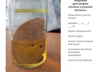 Жировая
дистрофия
«
печени гусиная
»
печень
Представлен участок
печени
___ ___
размеры х х
___ см
форма неправильная
жёлтого цвета
капсула тонкая гладкая
блестящая
-
на разрезе желтовато
оранжевая
однородная
консистенция дряблая
 