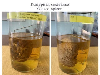 Глазурная селезенка
Glazed spleen
 