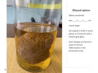 Glazed spleen
Spleen presented
size ___ x ___ x ___ cm
round shape
the capsule is thick in some
places, as if covered with a
whitish-gray glaze
Such changes are found in
cases of chronic
inflammation in the
peritoneal cavity.
 