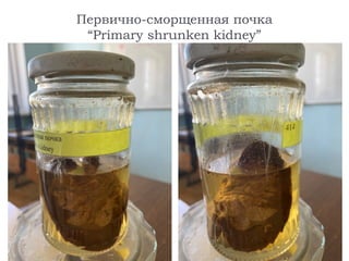 Первично-сморщенная почка
“Primary shrunken kidney”
 