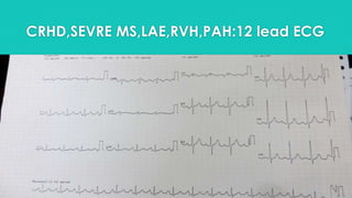 CRHD,SEVRE MS,LAE,RVH,PAH:12 lead ECG

 