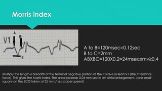 Morris index

A to B=0.12sec
B to C=2mm
ABXBC=0.12X2=0.24mmxsec≥0.0
4mmxsec
Multiply the length x breadth of the terminal negative portion of the P wave in lead V1 (the P terminal
force). This gives the Morris index. The area exceeds 0.04 mm-sec in left atrial enlargement. (one small
square on the ECG taken at 25 mm / sec paper speed)

 