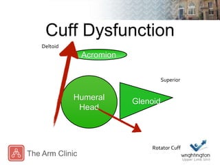 Cuff Dysfunction
Superior
Deltoid
Rotator Cuff
Acromion
Humeral
Head
Glenoid
 