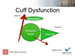 Cuff Dysfunction
Superior
Deltoid
Rotator Cuff
Acromion
Humeral
Head Glenoid
 