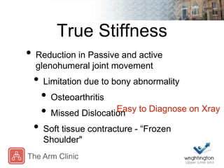 True Stiffness
• Reduction in Passive and active
glenohumeral joint movement
• Limitation due to bony abnormality
• Osteoa...