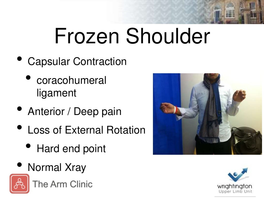 Assessment and Management of Frozen Shoulder