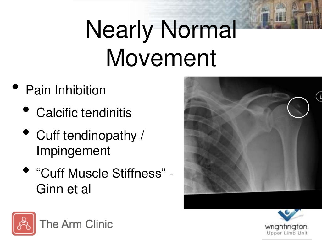 Assessment and Management of Frozen Shoulder