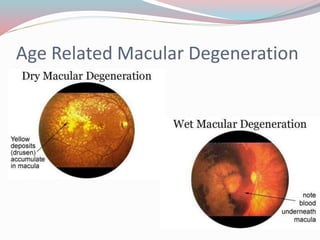 Age Related Macular Degeneration
 
