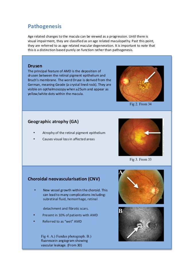 macular degeneration therapy