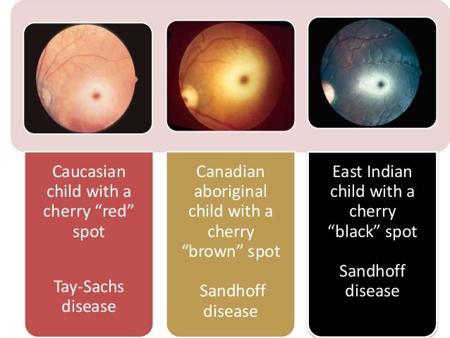 Macular cherry red spot
