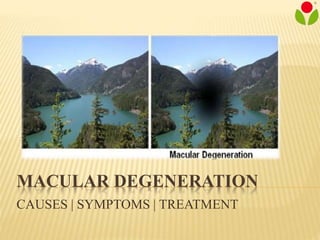 MACULAR DEGENERATION
CAUSES | SYMPTOMS | TREATMENT
 