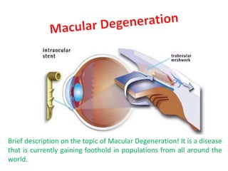 Brief description on the topic of Macular Degeneration! It is a disease
that is currently gaining foothold in populations from all around the
world.
 