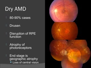 Dry AMD
 80-90% cases
 Drusen
 Disruption of RPE
function
 Atrophy of
photoreceptors
 End stage is
geographic atrophy
Loss of central vision
 