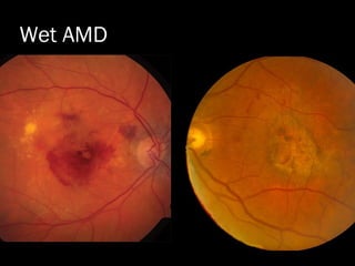 Wet AMD
 
