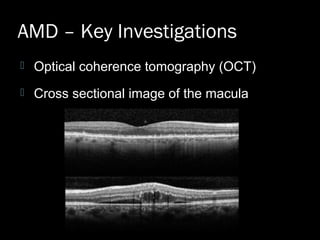 AMD – Key Investigations
 Optical coherence tomography (OCT)
 Cross sectional image of the macula
 