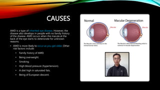 Macular Degeneration Presentation.pptx