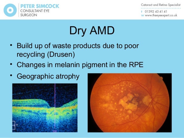Age Related Macular Degeneration Natural Treatment Age Related Macular Degeneration Natural Treatment
