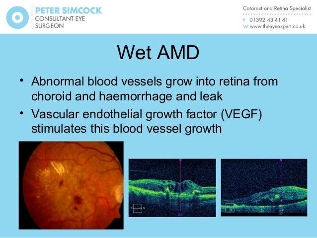 Natural Treatment For Wet Amd Natural Treatment For Wet Amd