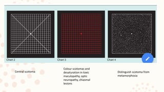 Central scotoma
Colour scotomas and
desaturation in toxic
maculopathy, optic
neuropathy, chiasmal
lesions
Distinguish scotoma from
metamorphosia
 