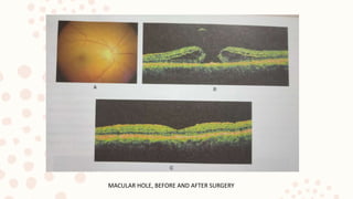 MACULAR HOLE, BEFORE AND AFTER SURGERY
 