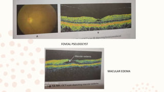 FOVEAL PSEUDOCYST
MACULAR EDEMA
 