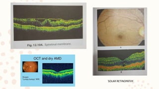 SOLAR RETINOPATHY
 