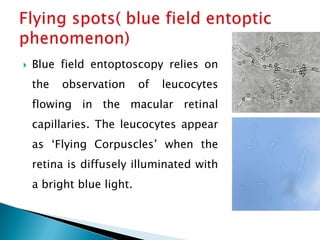    Blue field entoptoscopy relies on
    the   observation      of   leucocytes
    flowing in the macular retinal
    capillaries. The leucocytes appear
    as ‘Flying Corpuscles’ when the
    retina is diffusely illuminated with
    a bright blue light.
 