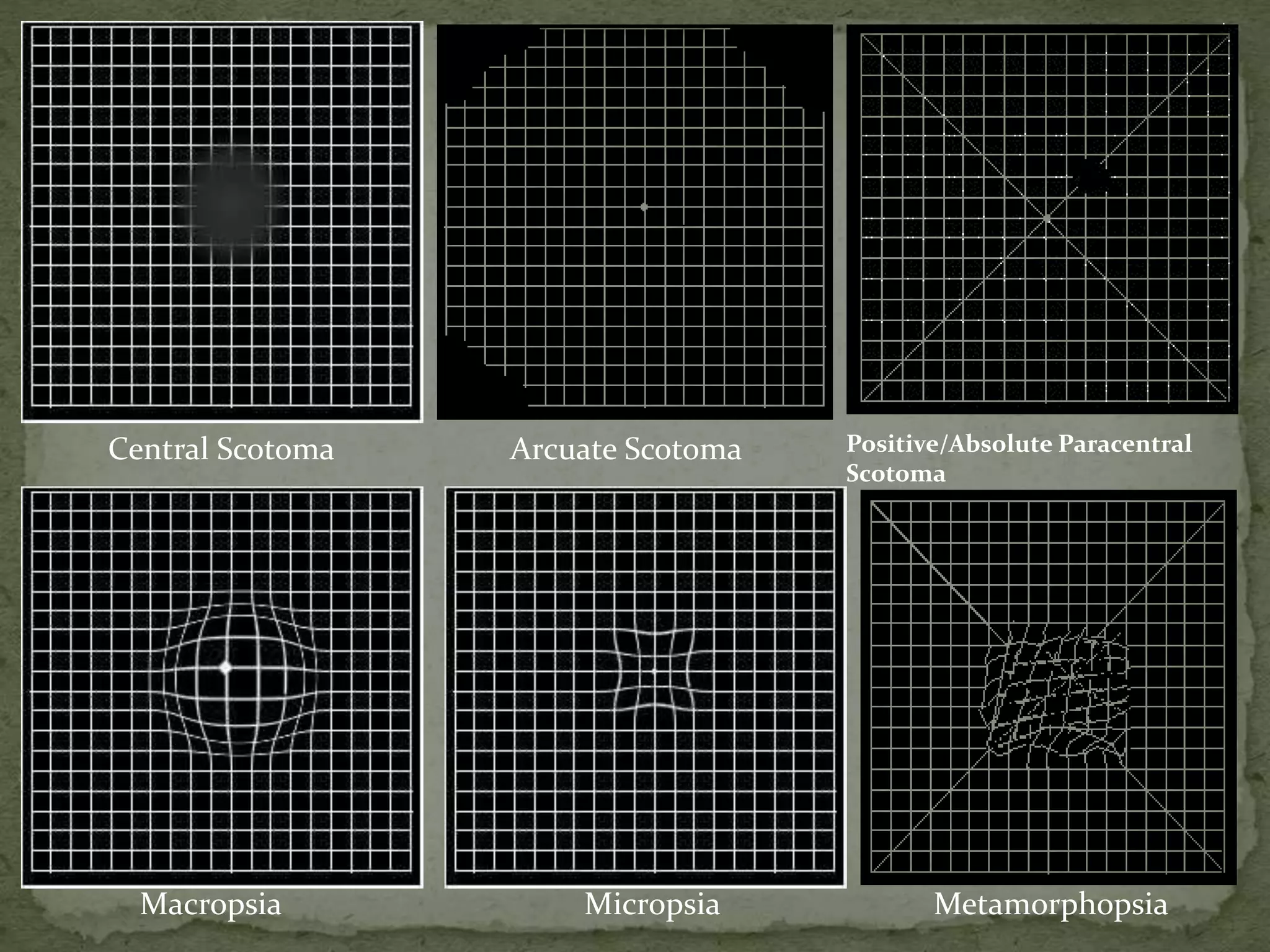 MetamorphopsiaMicropsiaMacropsia
Positive/Absolute Paracentral
Scotoma
Arcuate ScotomaCentral Scotoma
 